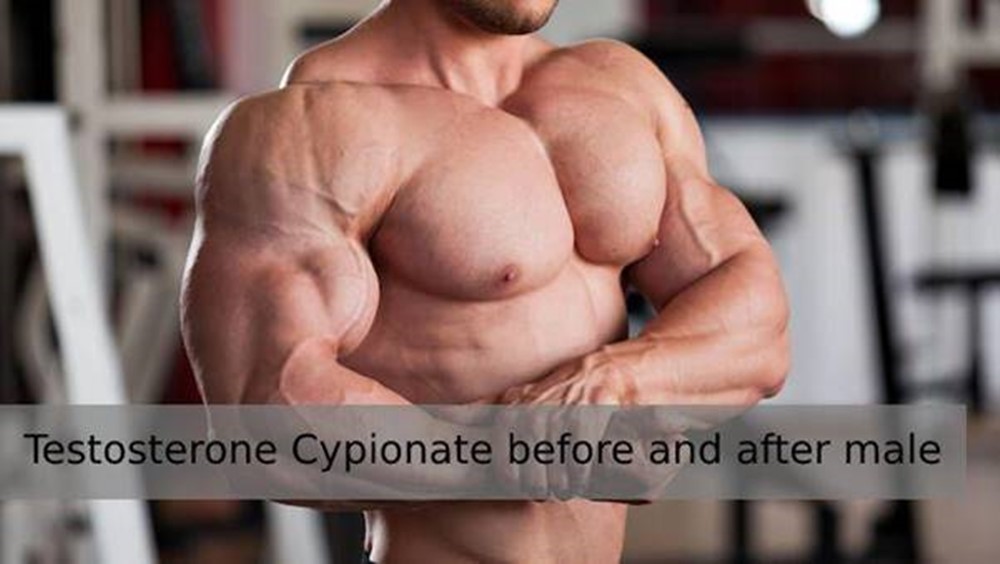 Administration of the injectable steroid Testosterone Cypionate in male
